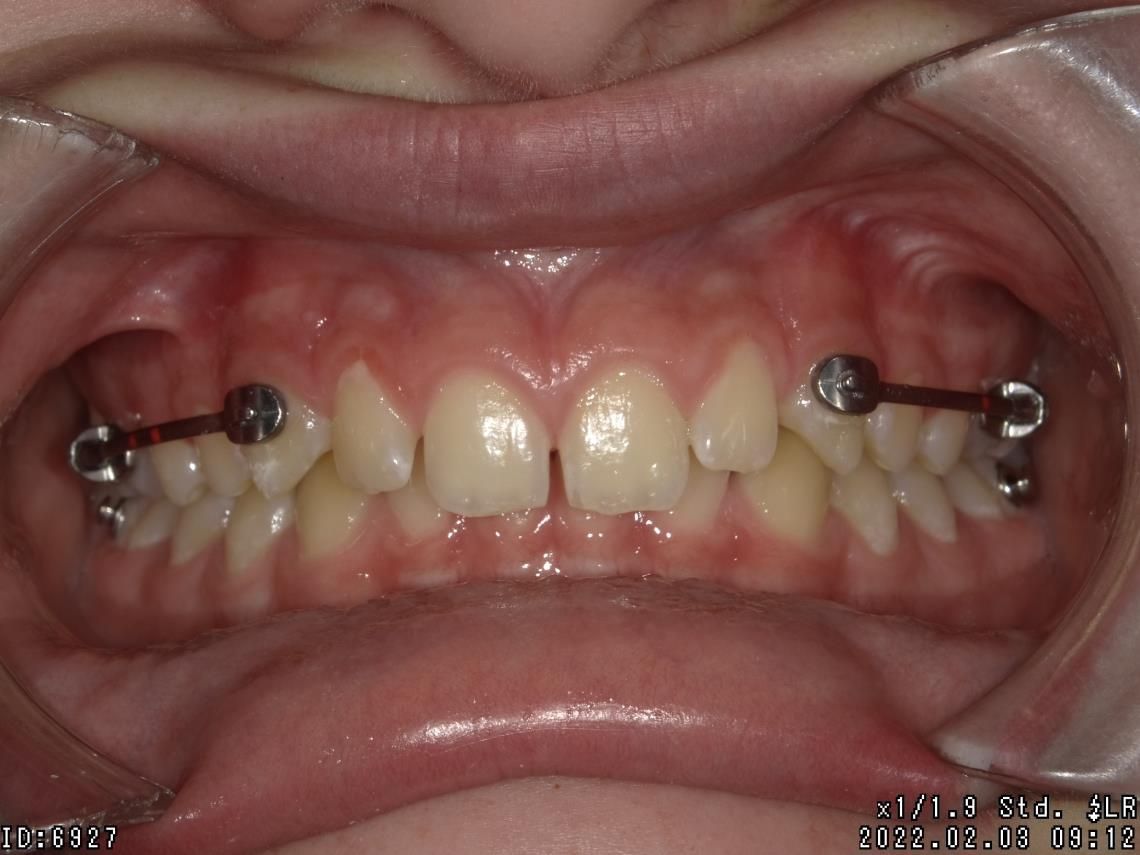 Appareillages orthodontiques fixes – Dr Albert Jung