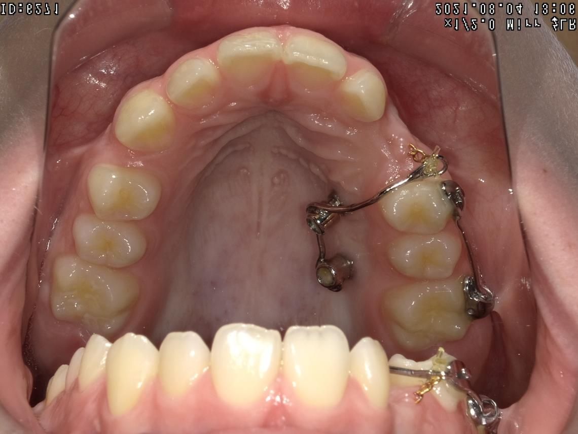 Appareillages orthodontiques fixes – Dr Albert Jung