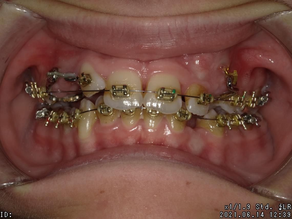 Appareillages orthodontiques fixes – Dr Albert Jung