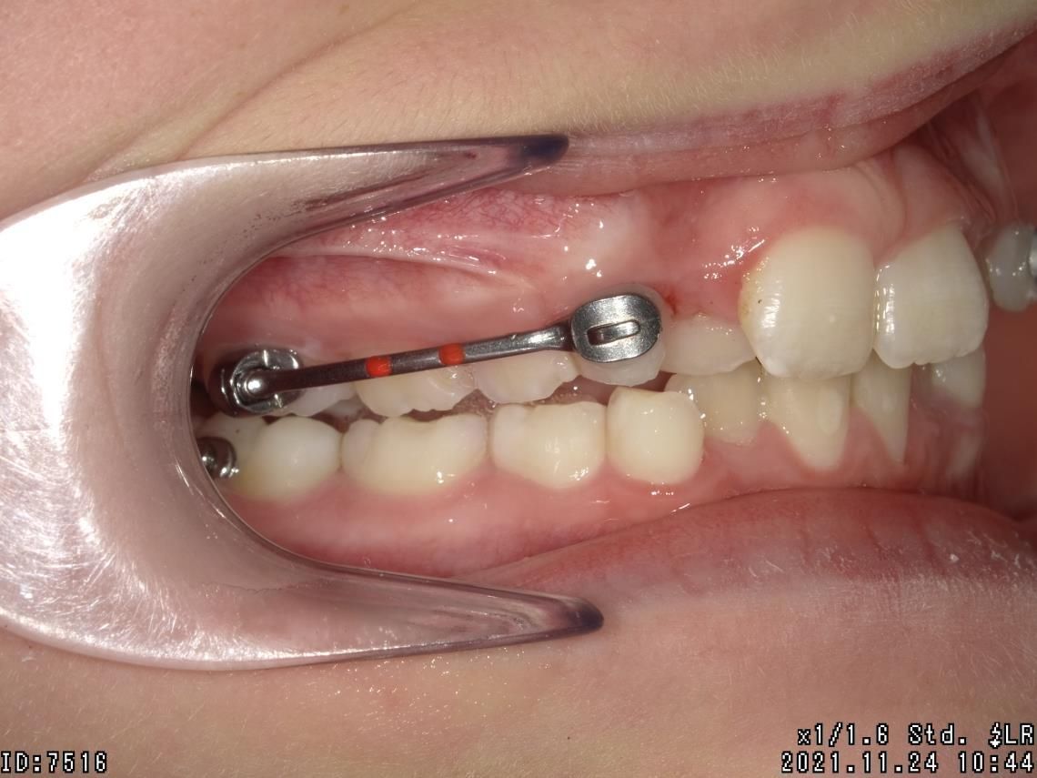 Appareillages orthodontiques fixes – Dr Albert Jung