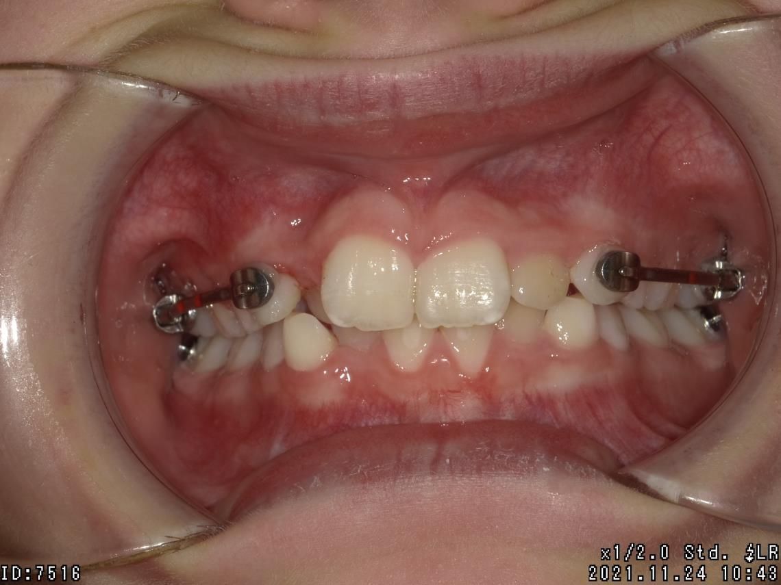 Appareillages orthodontiques fixes – Dr Albert Jung