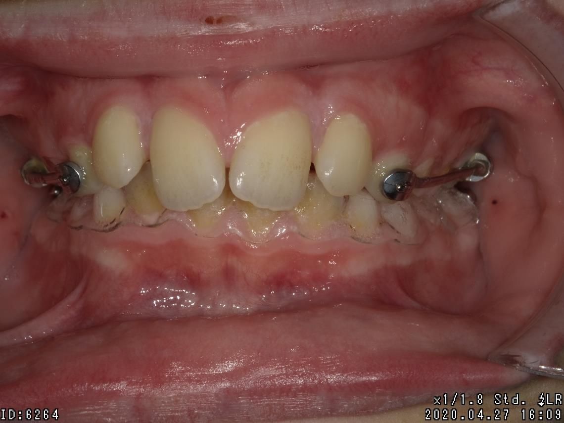 Appareillages orthodontiques fixes – Dr Albert Jung