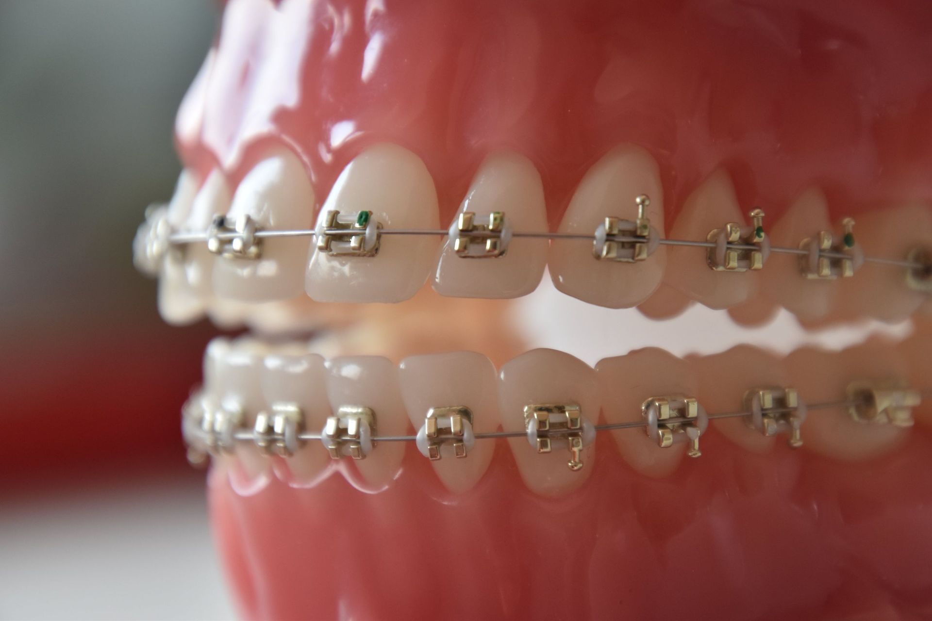 Appareillages orthodontiques fixes – Dr Albert Jung