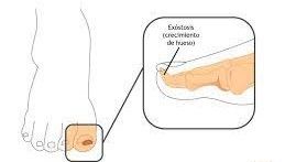 Cirugía de uña por presentar exóstosis subungueal (Pico de hueso en la falange del dedo)