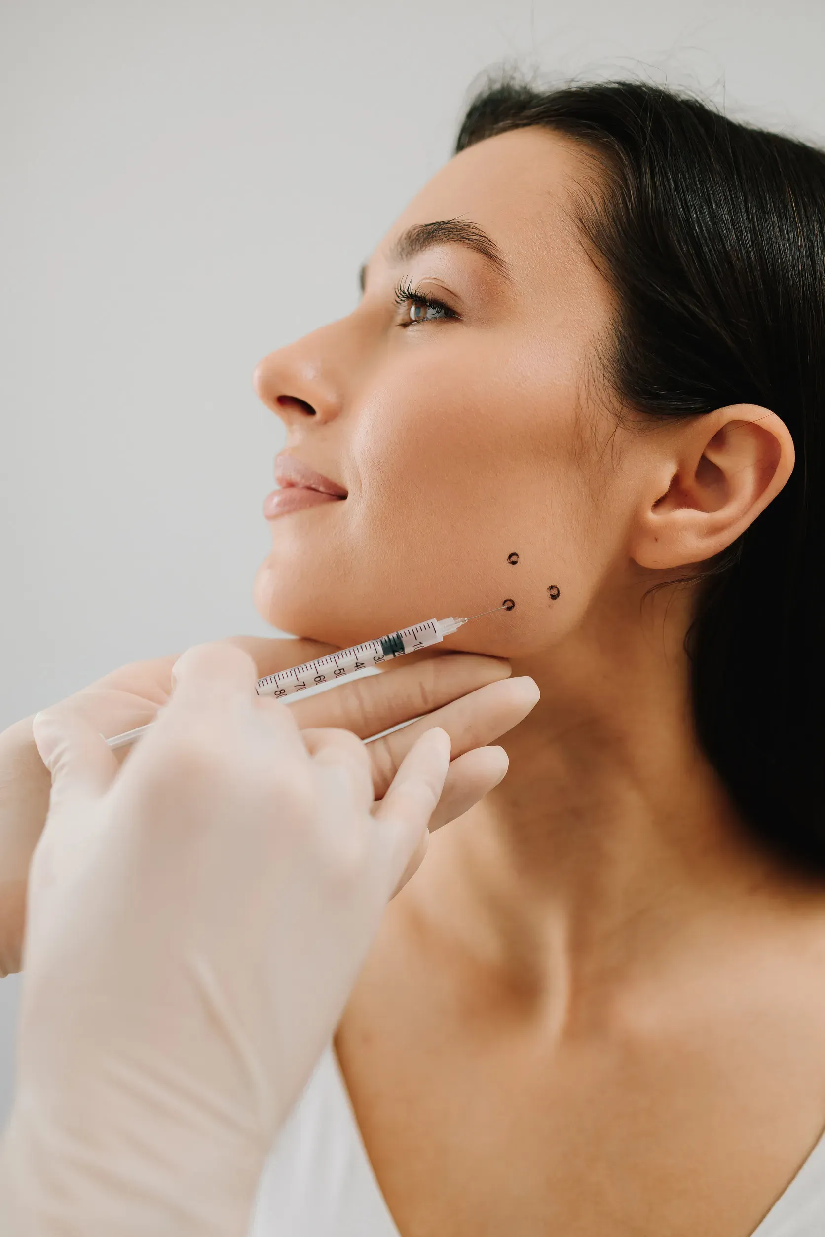 Rostro de una persona con líneas dibujadas, preparándose para un procedimiento cosmético. Se ven manos enguantadas de azul.