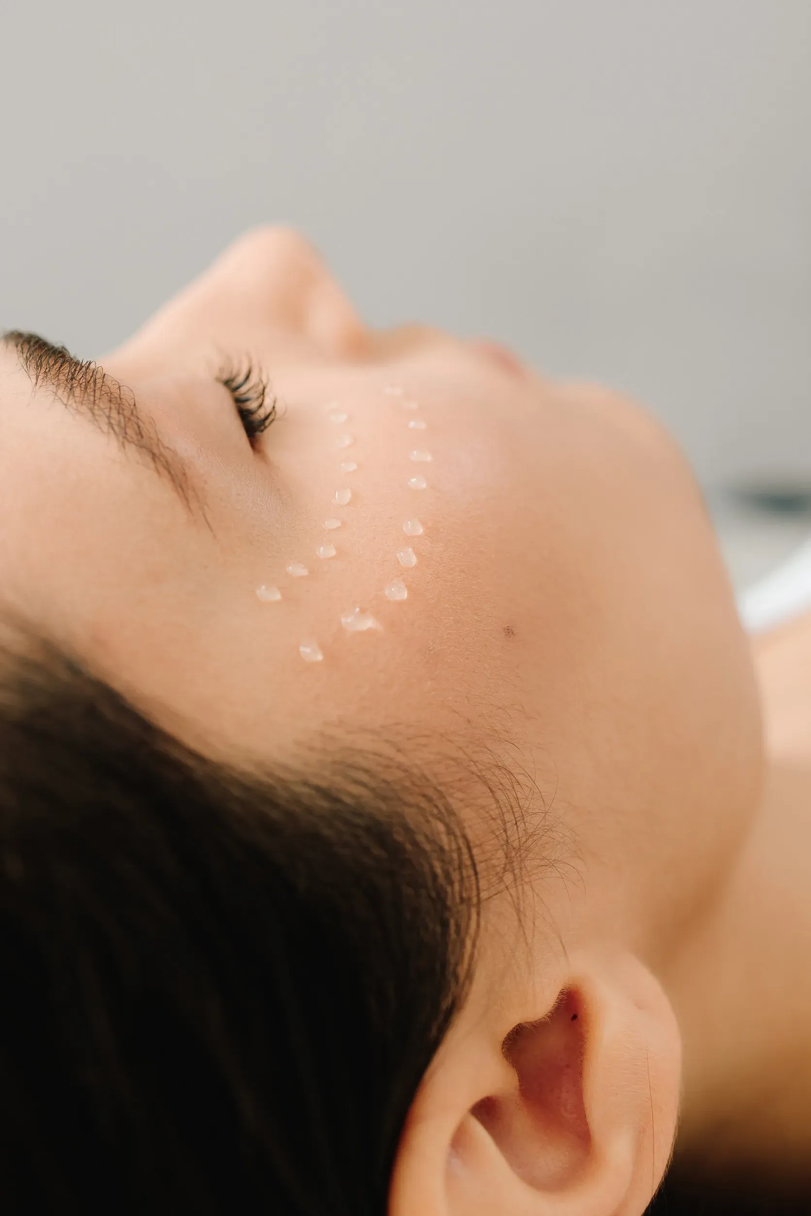 Rostro de una persona de perfil, con pequeños puntos de producto en la mejilla.