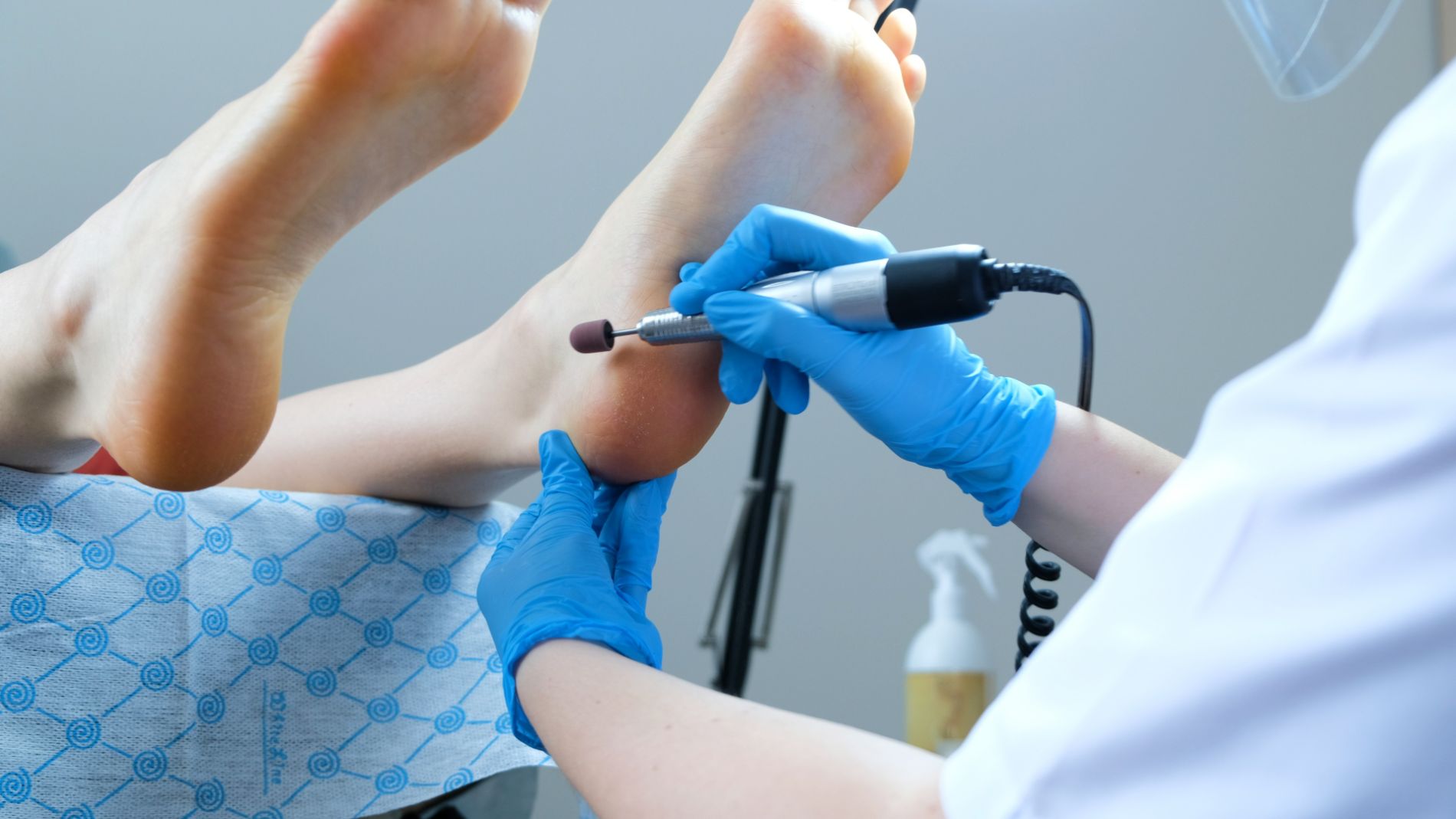 Foto Hornhautentfernung