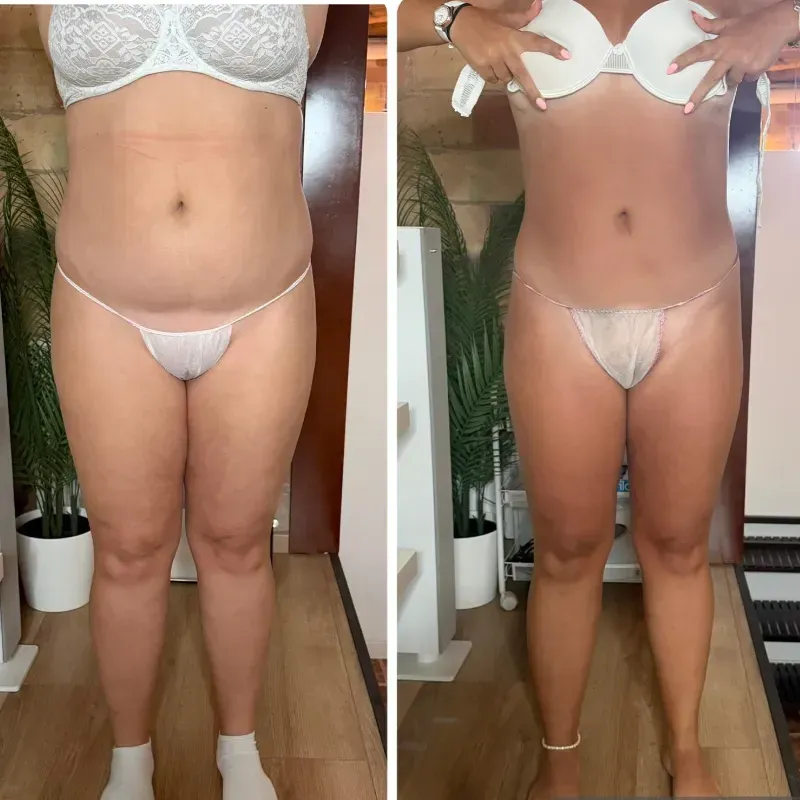 Fotos comparativas del antes y el después de la transformación corporal, en lencería blanca y calcetines.