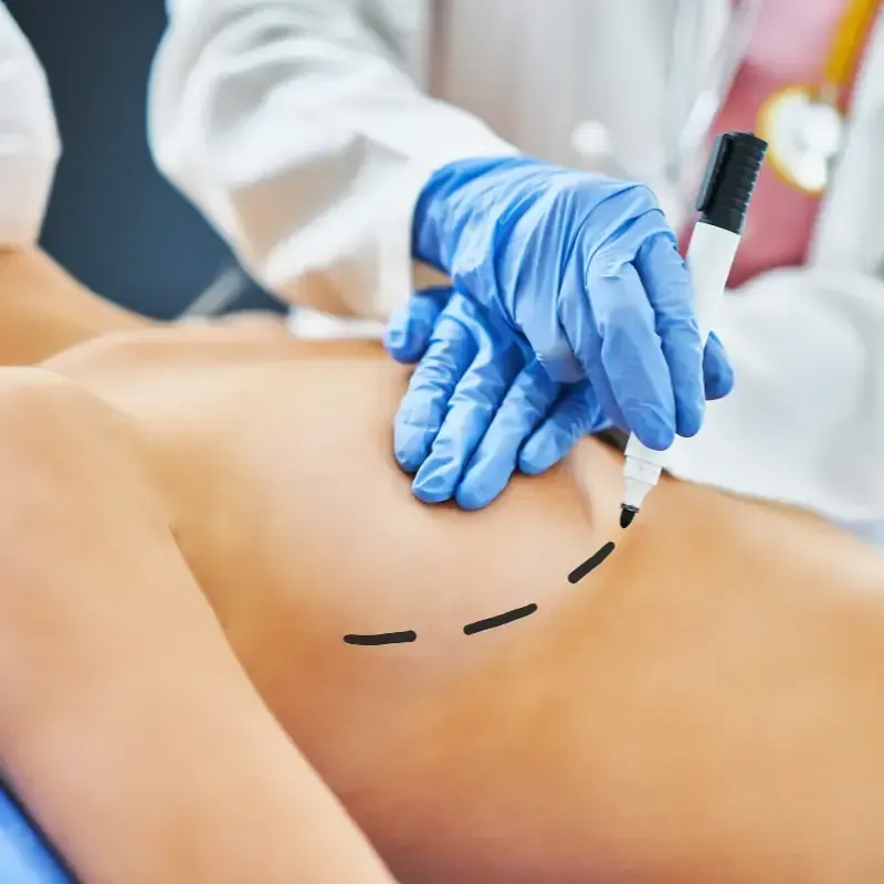 Manos de un médico con guantes azules marcando el pecho de una mujer con un bolígrafo, delineando una incisión quirúrgica.