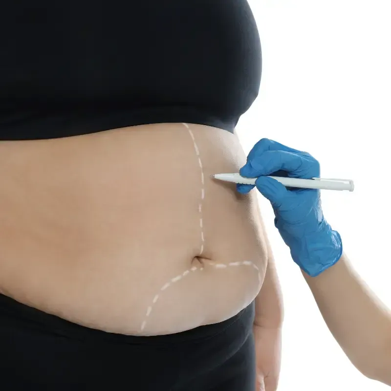 Mano en guante azul dibujando marcas quirúrgicas en el abdomen de una persona.