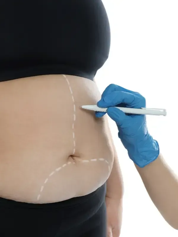 Abdomen de una persona marcado con un bolígrafo por una mano enguantada, preparándose para un procedimiento médico.