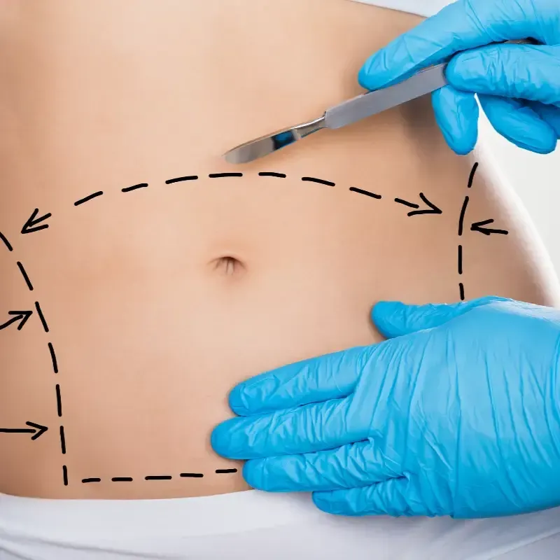 Abdomen de una persona con marcas quirúrgicas y manos enguantadas sosteniendo un bisturí. Ilustración del procedimiento.