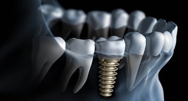 Una imagen generada por computadora de un implante dental en la boca de una persona.