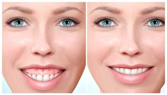 Una fotografía de antes y después de la sonrisa de una mujer.