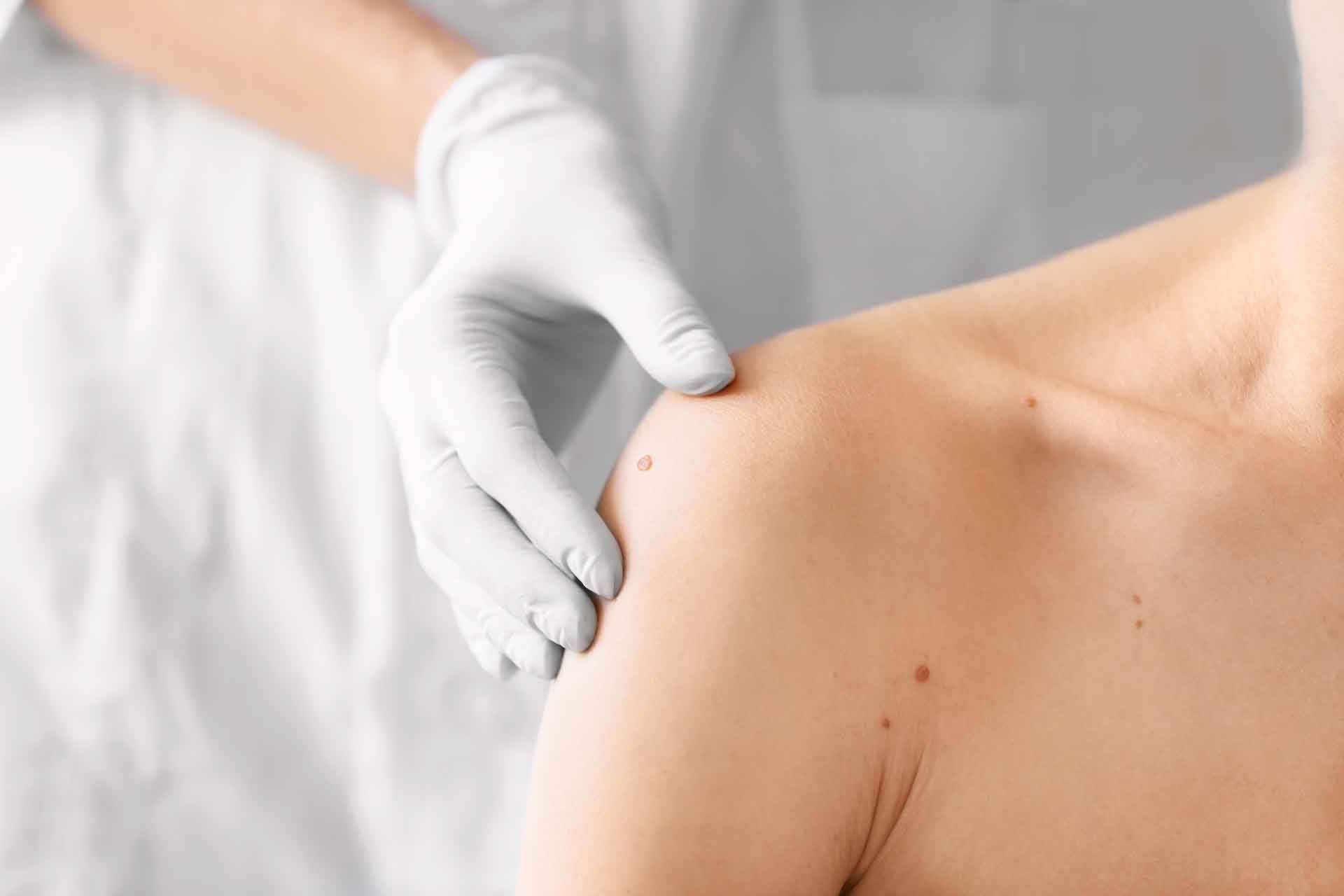 Dermatologue examinant un grain de beauté