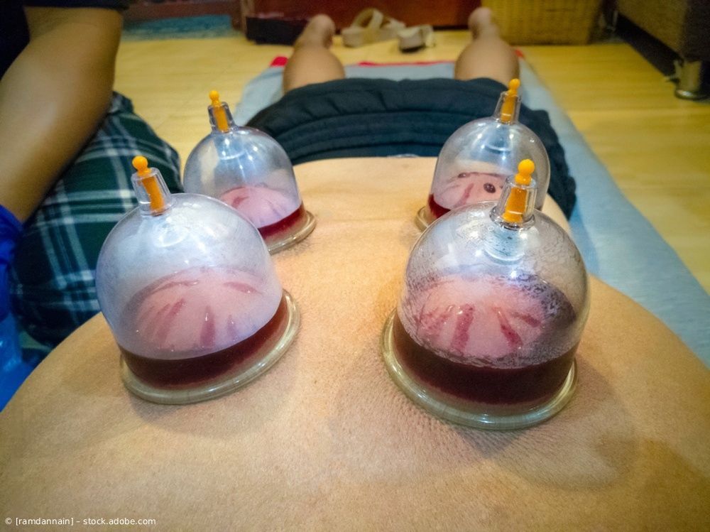 Vier Schröpfgläser mit roter Flüssigkeit auf dem Rücken einer Person während einer Massagebehandlung.