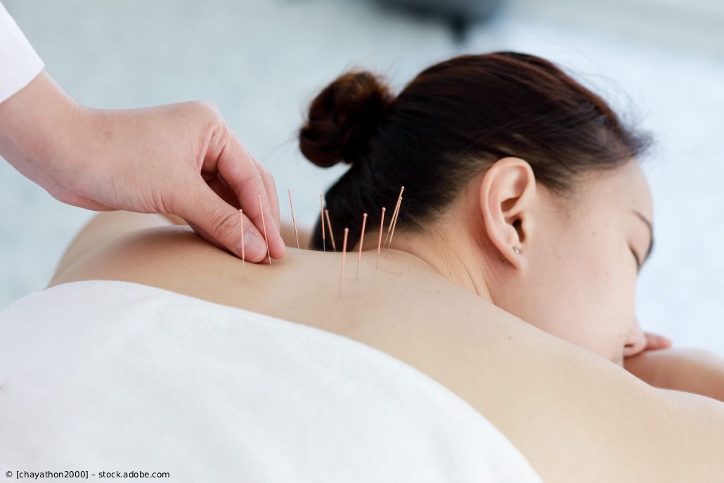 Hände, die in einem Spa-Umfeld Akupunkturnadeln auf dem oberen Rücken einer Frau platzieren
