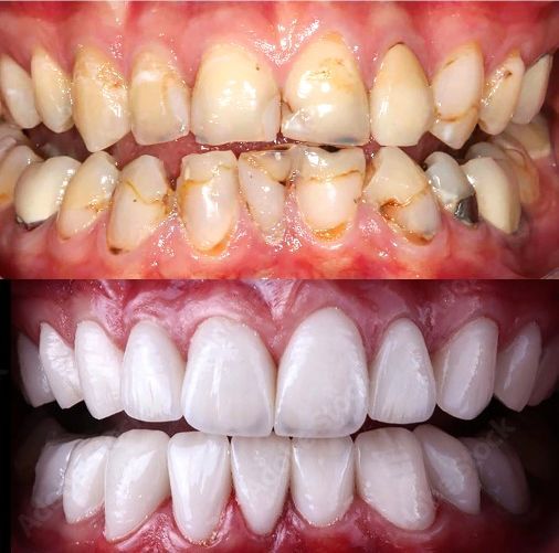 Ein Vorher-Nachher-Bild der Zähne einer Person