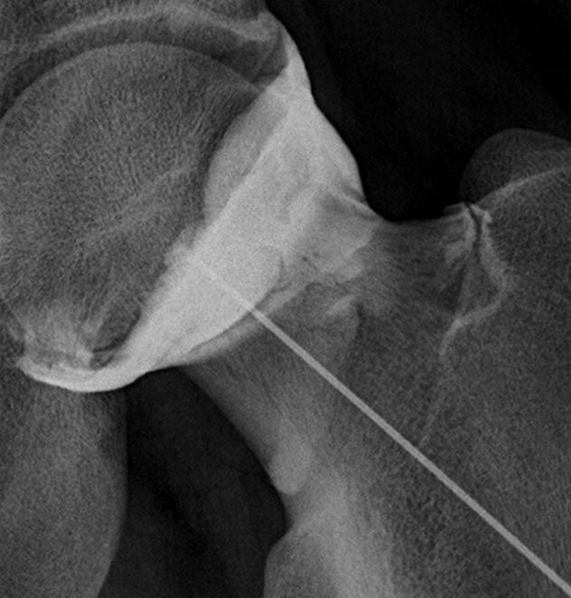 Radiographie d'une articulation de la hanche avec une fine broche ou aiguille métallique insérée en diagonale