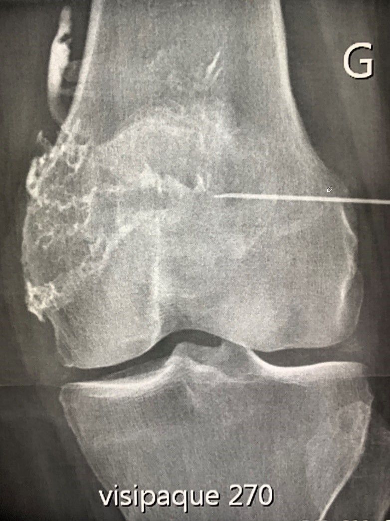 Radiographie du genou montrant des lésions articulaires graves et une broche ou un fil métallique traversant l'os supérieur