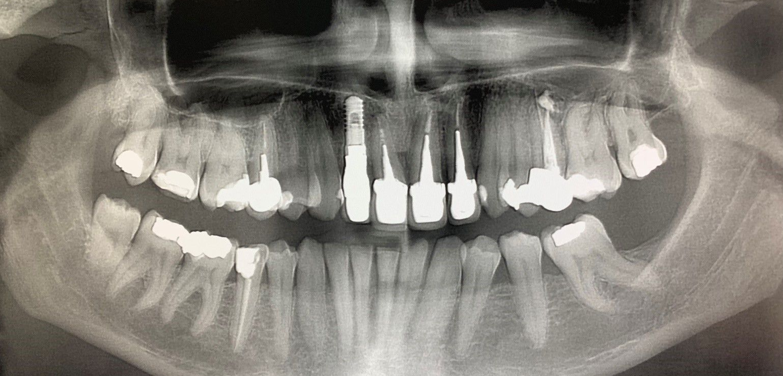Radiographie dentaire panoramique montrant les dents supérieures et inférieures ainsi que la structure de la mâchoire