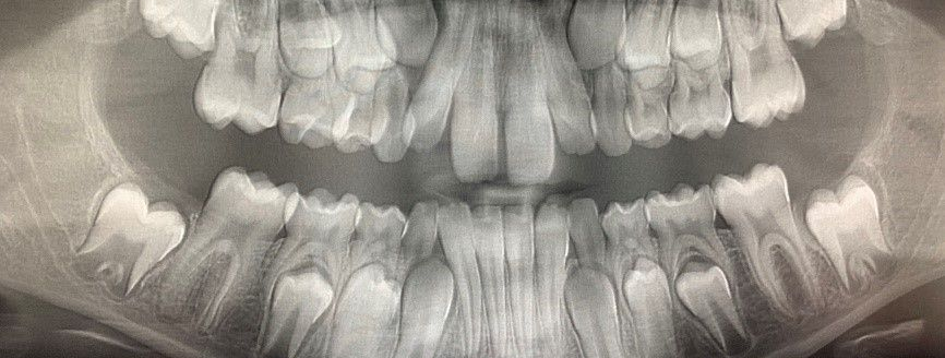 Radiographie des incisives supérieures et inférieures montrant l'éruption des molaires et la visibilité des racines dentaires.