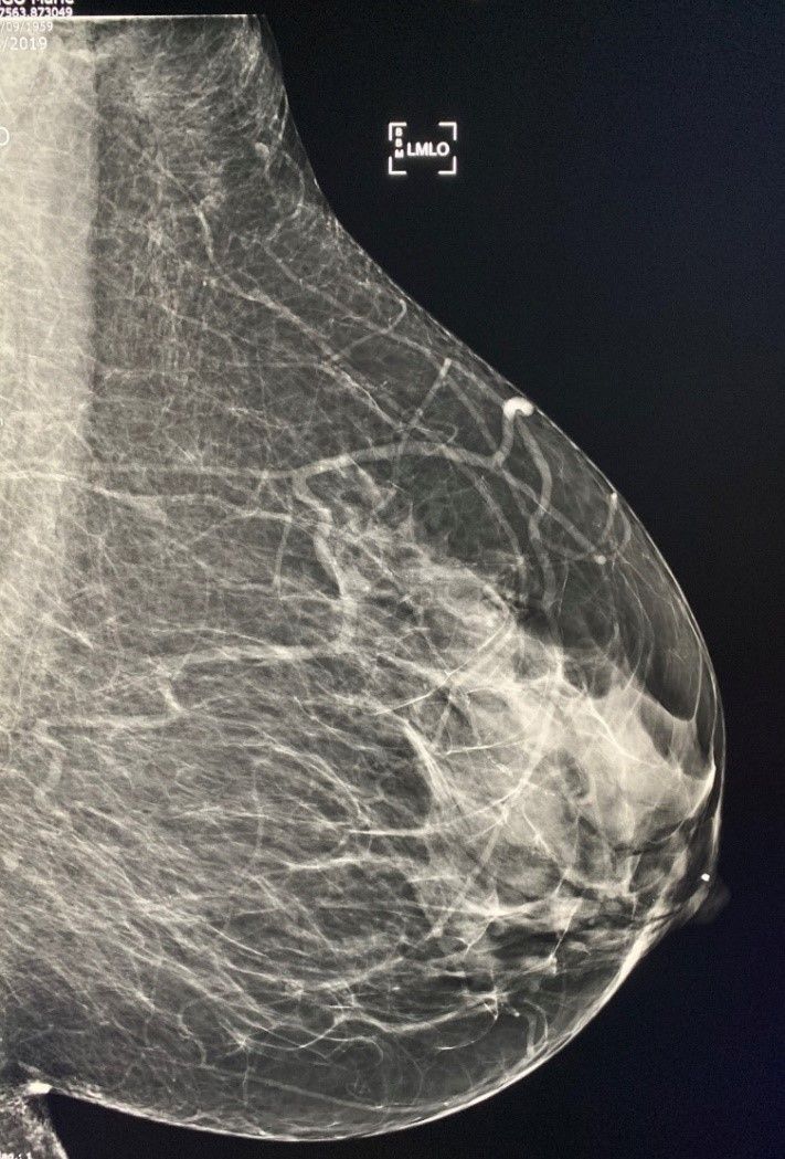 Mammographie en niveaux de gris montrant un sein de profil avec un tissu dense et un petit marqueur près du haut.