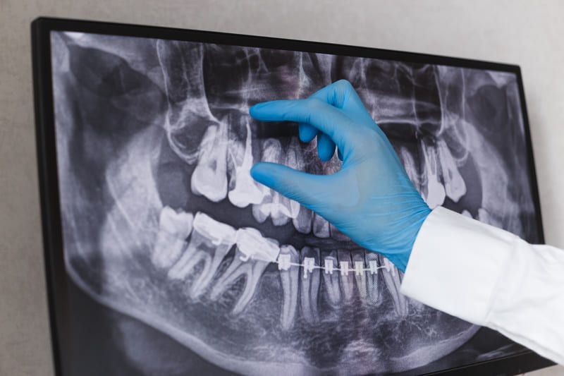 Wurzelbehandlung | Zahnarztpraxis am Wall Dr. Bode-Hirsch