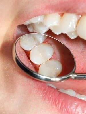 Ein Zahnarzt untersucht die Zähne einer Person mit einem Spiegel | Zahnarztpraxis am Wall Dr. Bode-Hirsch