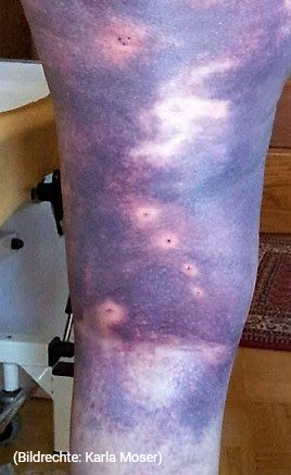 Großflächiger Bluterguss am Bein. An den hellen Stellen hat sich der Bluterguss nach der
Blutegeltherapie aufgelöst.