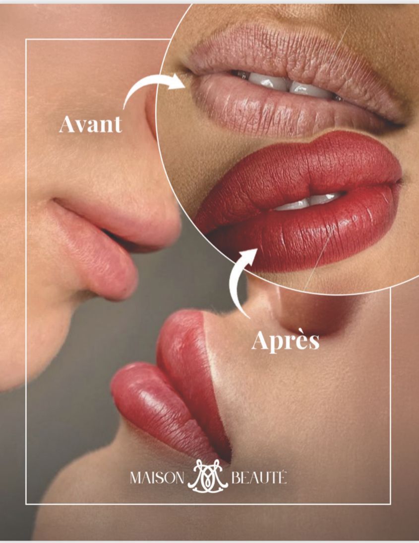 Comparaison des lèvres : avant (pâles) et après (pulpeuses), indiquant une augmentation du volume des lèvres.