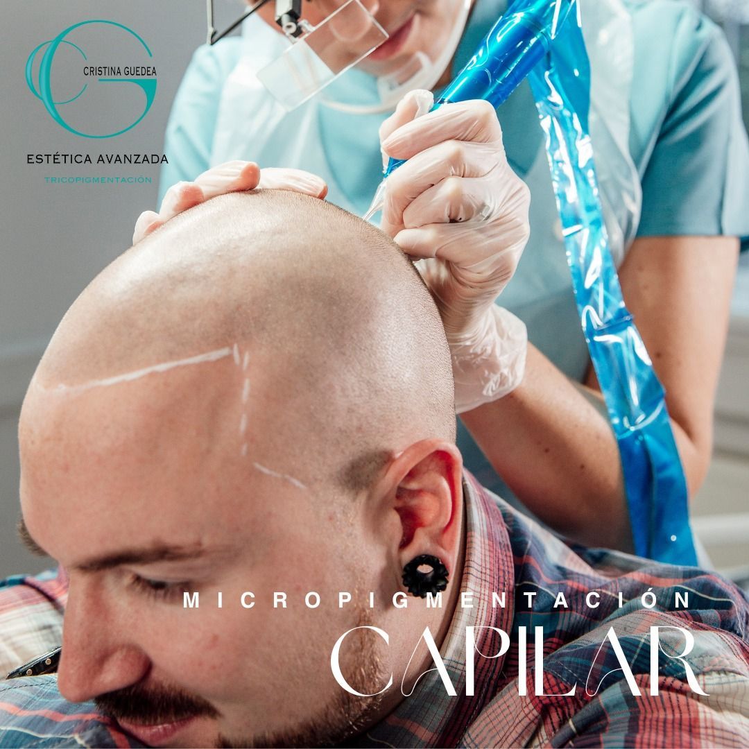 Un hombre está recibiendo un tratamiento de micropigmentación en la cabeza.