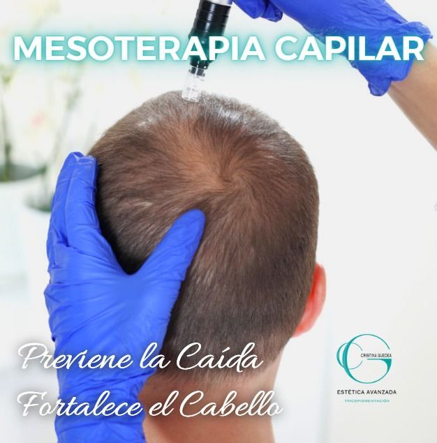 Un hombre está recibiendo un tratamiento capilar llamado mesoterapia capilar.