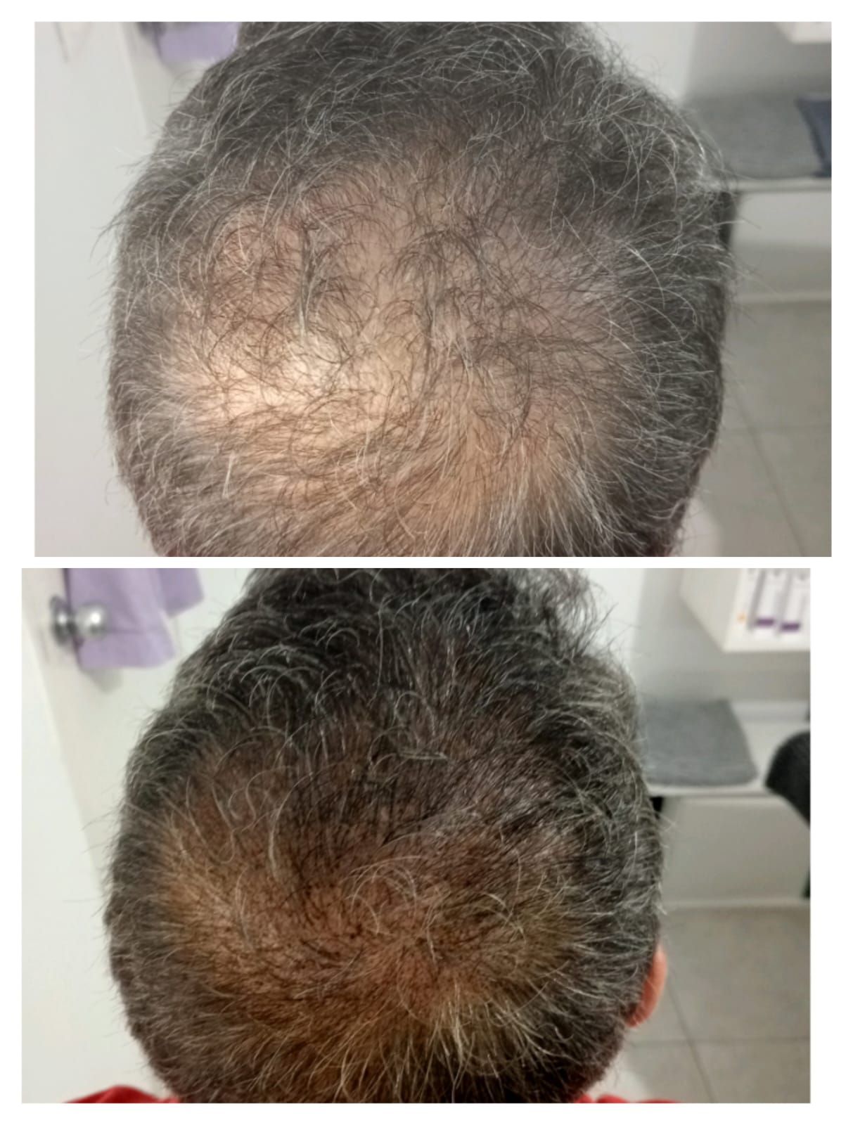 Una fotografía de antes y después del crecimiento del cabello de un hombre.