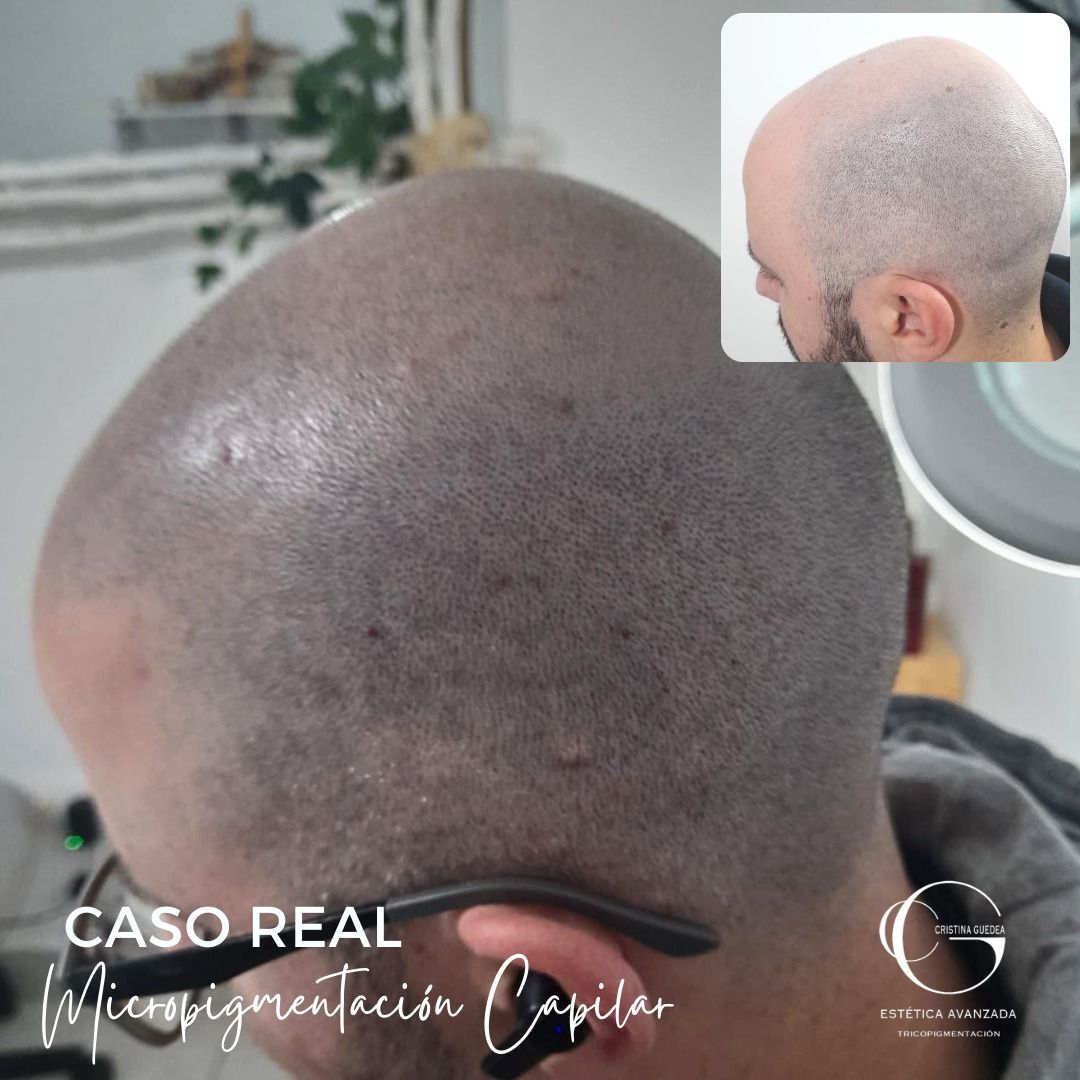 Una imagen de la cabeza de un hombre con la leyenda caso real micropigmentacion capilar