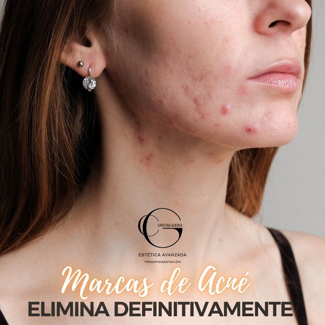 Una mujer con acné en la cara y las palabras marcas de acné elimina definitivamente
