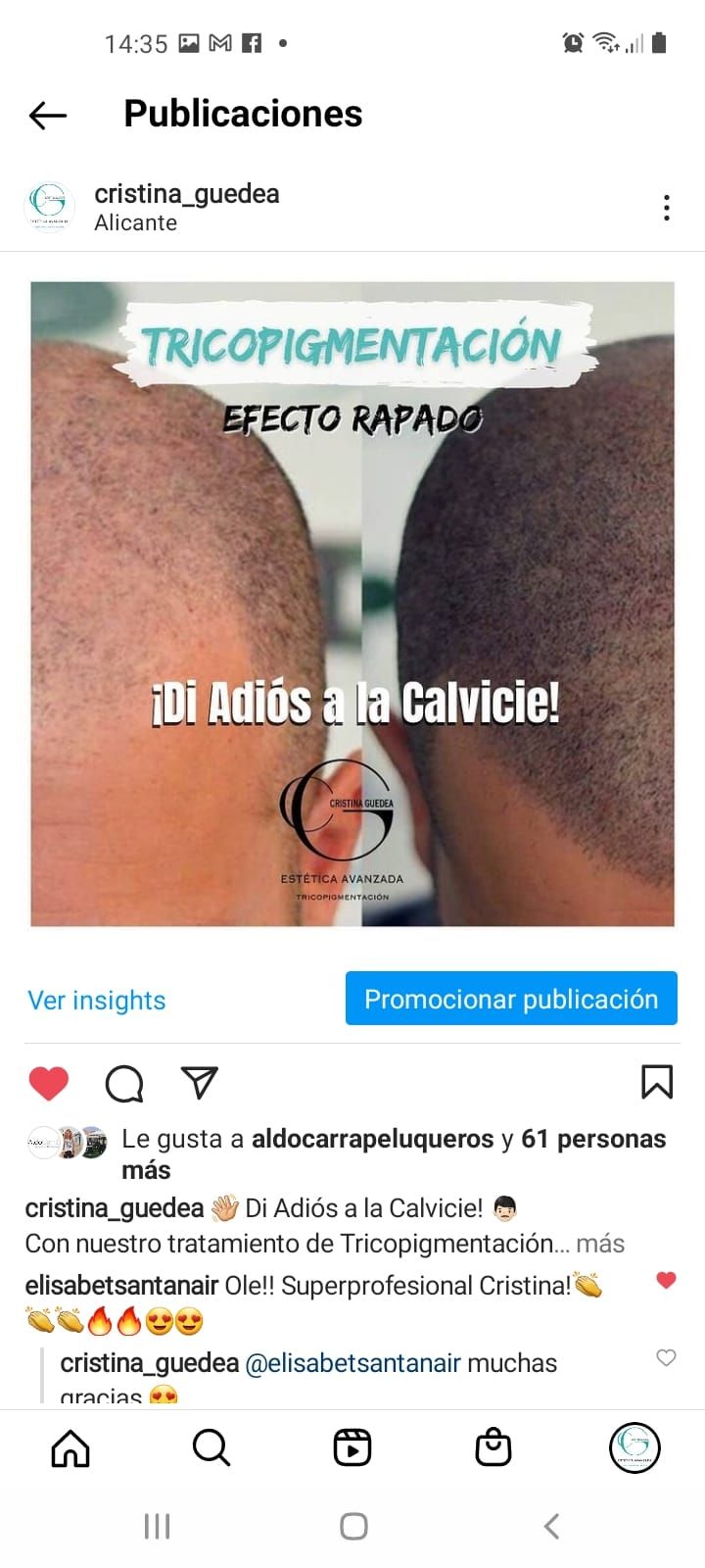 Una fotografía de la cabeza de una persona antes y después de un trasplante de cabello.