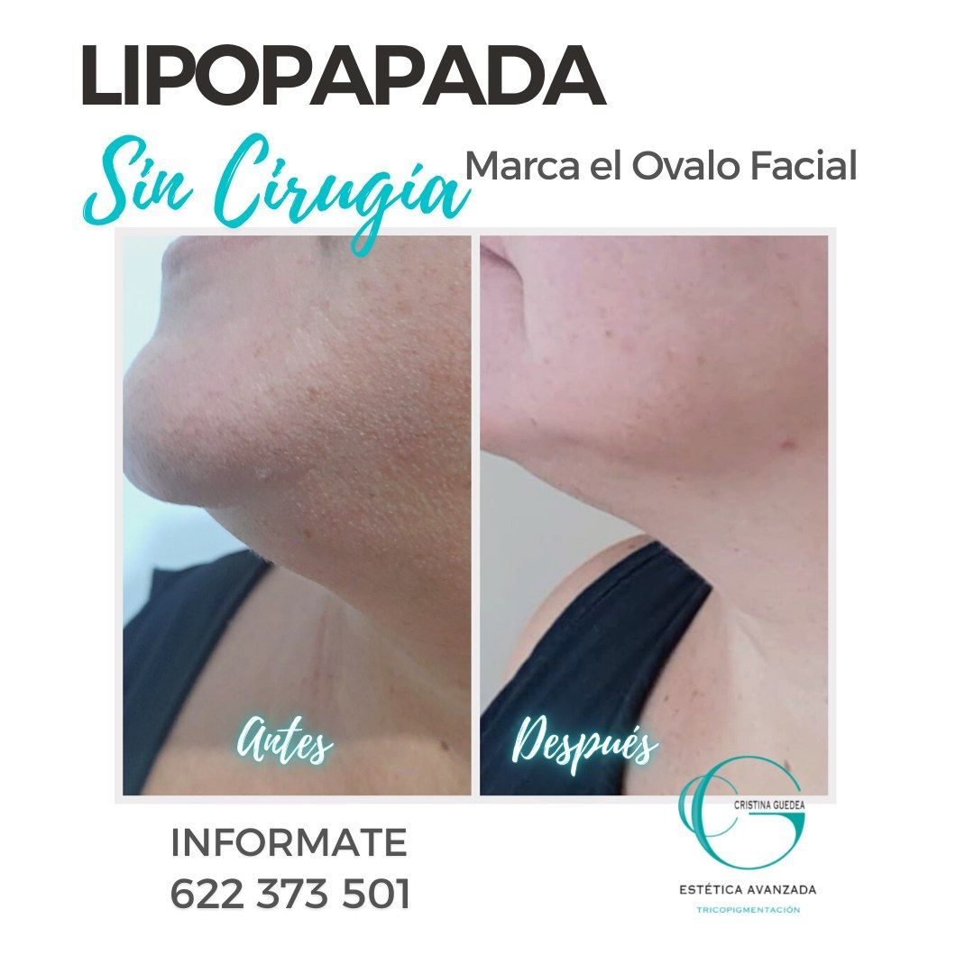 Una imagen del cuello de una mujer antes y después de la lipopapada.