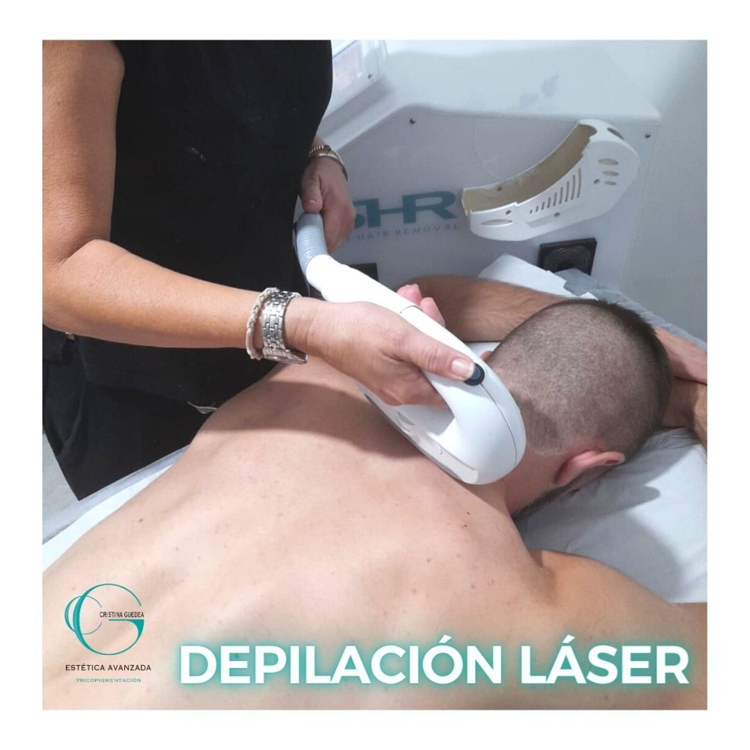 Un hombre está recibiendo un tratamiento de depilación láser en la espalda.