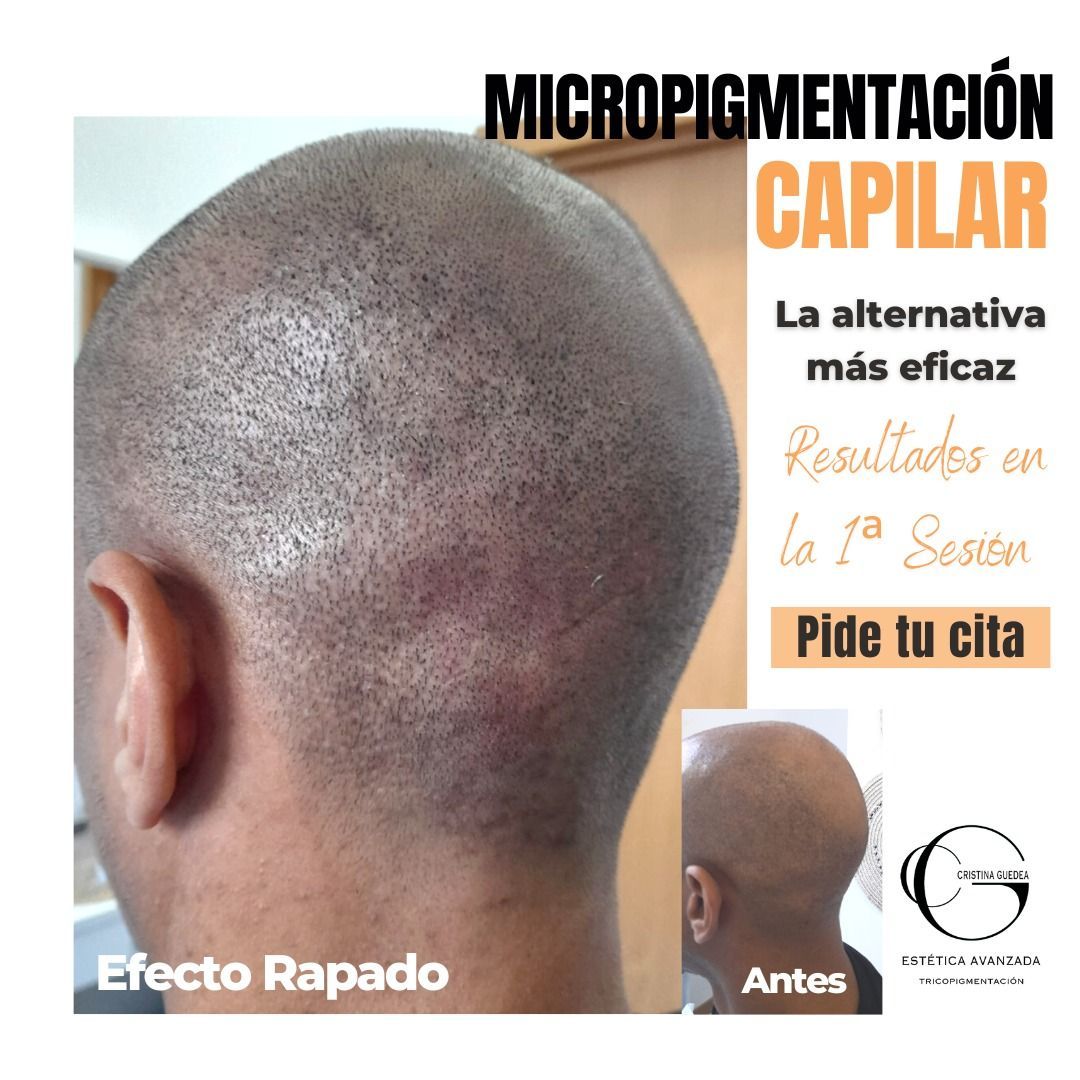 Una imagen de la cabeza de un hombre con las palabras micropigmentacion capilar en ella