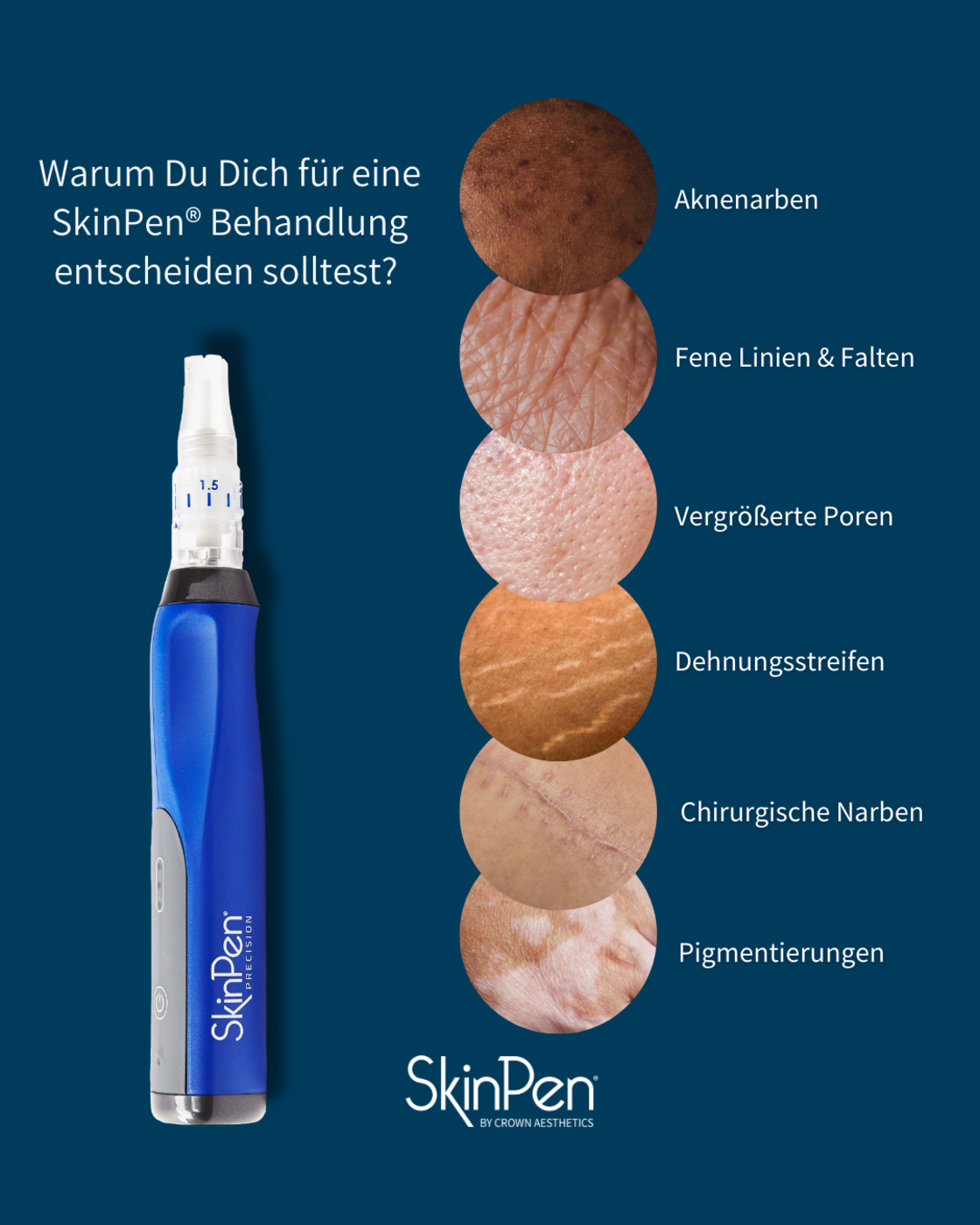Ein blaues SkinPen-Gerät neben einer Liste der Hautprobleme, die es behandelt: Aknenarben, feine Linien, Poren, Dehnungsstreifen und Flecken.
