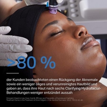 Eine Person, die sich einer HydraFacial-Behandlung unterzieht; im Text wird eine Zufriedenheit von über 80 % hinsichtlich Akne und Hautbild hervorgehoben.