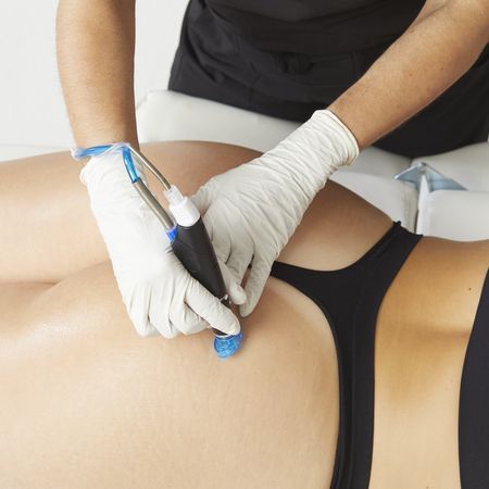 Ein Techniker mit Handschuhen führt eine Behandlung mit einem kosmetischen Laserhandstück auf der Haut einer Person durch.