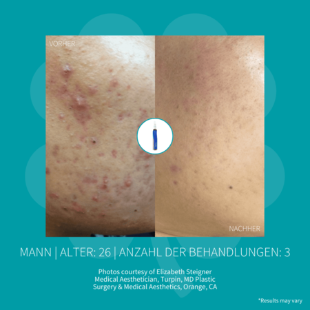Vorher-Nachher-Vergleich der Haut mit reduzierter Akne nach drei medizinisch-ästhetischen Behandlungen.