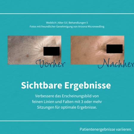 Vorher-Nachher-Vergleich der Hautstruktur, der eine Reduzierung feiner Linien nach fünf Mikroneedling-Sitzungen zeigt.