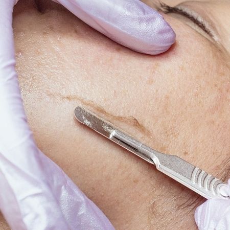 Mit einem Skalpell wird mithilfe einer behandschuhten Hand ein Dermaplaning an der Wange einer Person durchgeführt.