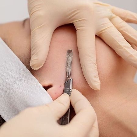 Mit einem behandschuhten Handgelenk wird mithilfe eines Skalpells ein Dermaplaning an der Wange durchgeführt.