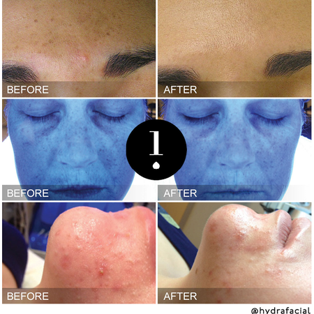 Vorher-Nachher-Vergleiche, die die Verbesserung des Hautbildes nach einer HydraFacial-Behandlung zeigen, dargestellt in drei Gruppen.