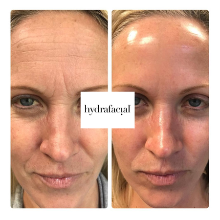 Vorher-nachher-Vergleich einer HydraFacial-Behandlung, der eine Reduzierung der Stirnfalten und eine glattere, hydratisierte Haut zeigt.