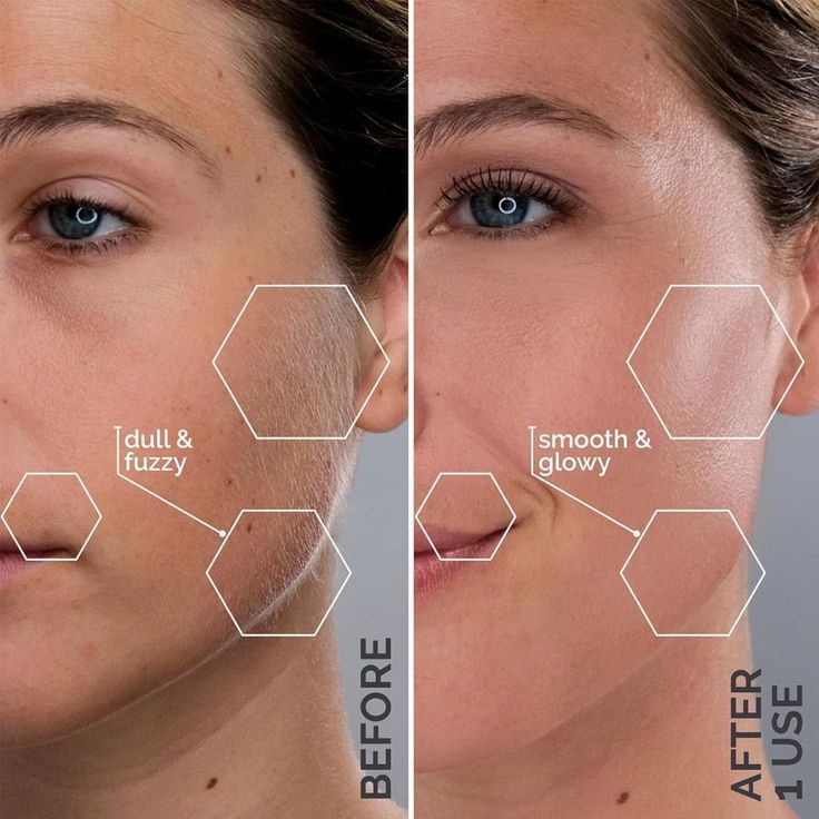 Eine Anzeige für SkinPen hebt folgende Vorteile hervor: FDA-zertifiziert, klinisch sicher, schnell und chemikalienfrei.